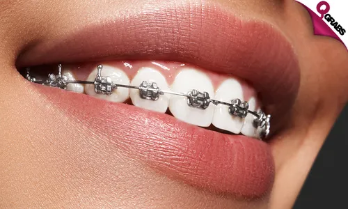 Metal Braces, Adjustment & Retainers!
